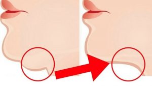 عوارض ساکشن غبغب | پزشک زیبایی اصفهان