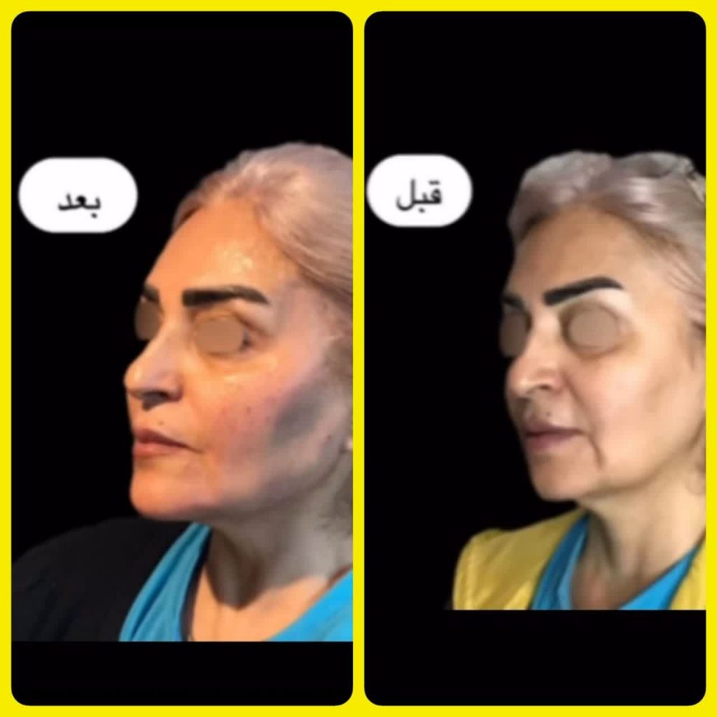 کانتورینگ کامل صورت با فیلر | پزشک زیبایی اصفهان | دکتر مجید حسینی