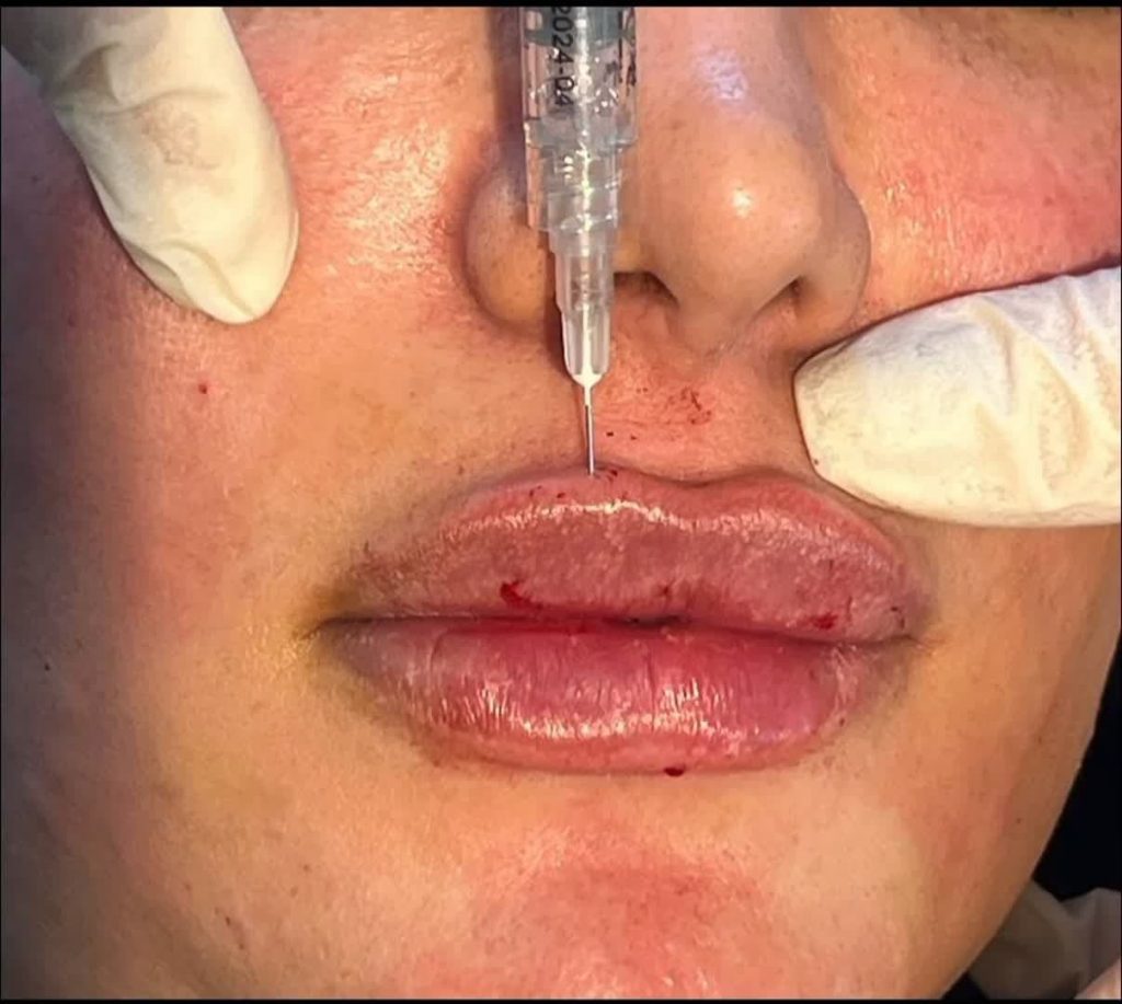 نمونه تزریق یک سی سی فیلر لب | پزشک زیبایی اصفهان | دکتر مجید حسینی
