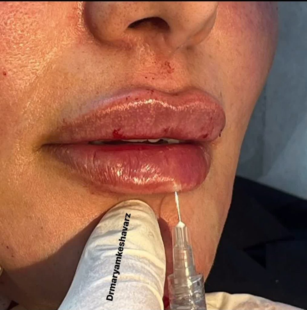 نمونه تزریق یک سی سی فیلر لب | پزشک زیبایی اصفهان | دکتر مجید حسینی