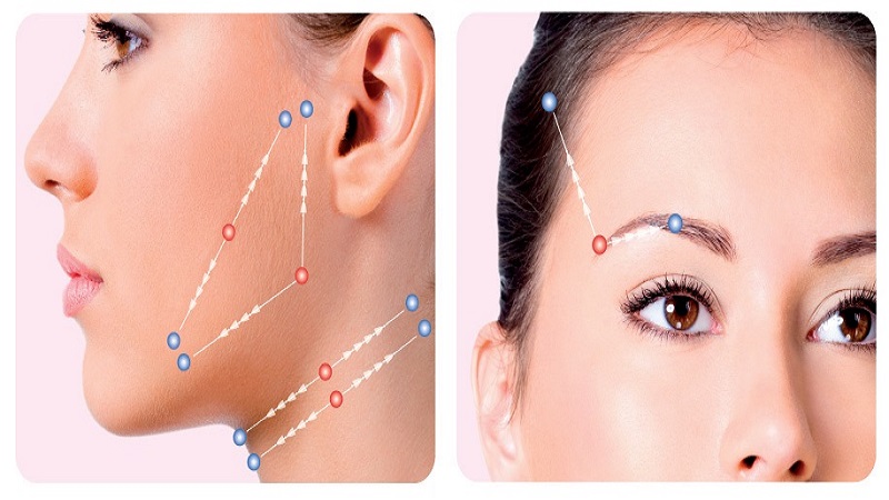 بررسی کارگذاری نخ سیلویت آمریکایی برای لیفت صورت