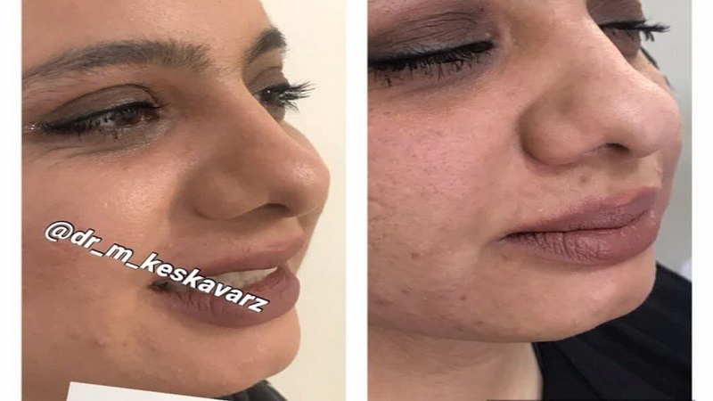نمونه کوچک کردن بینی با پلاسمای بینی توسط دکتر مجید حسینی