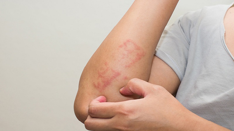 عوامل تشدید انواع اگزما