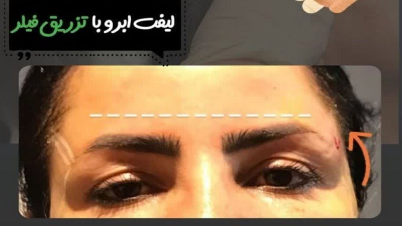 لیفت ابرو با تزریق فیلر | پزشک زیبایی اصفهان | دکتر مجید حسینی | از بین رفتن چین و چروک های پیشانی، پل بینی و میان ابروها