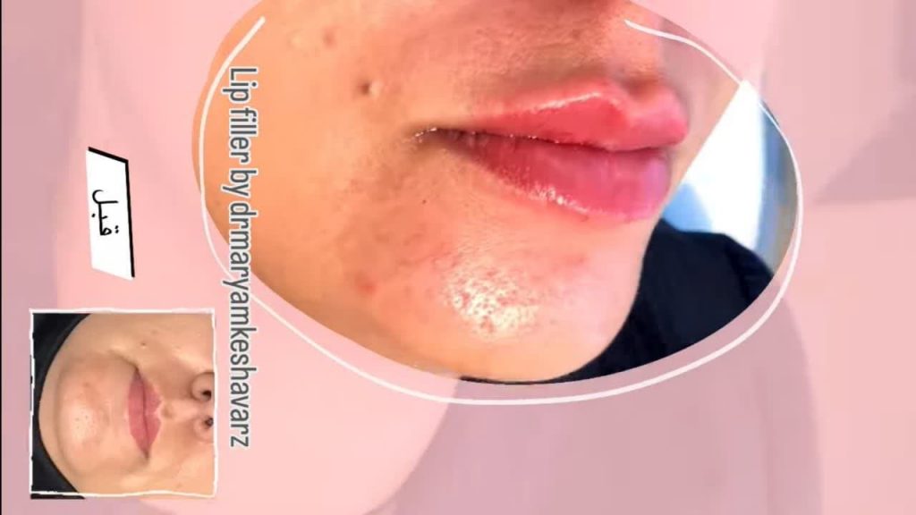 تزریق فیلر لب | پزشک زیبایی اصفهان | دکتر مجید حسینی