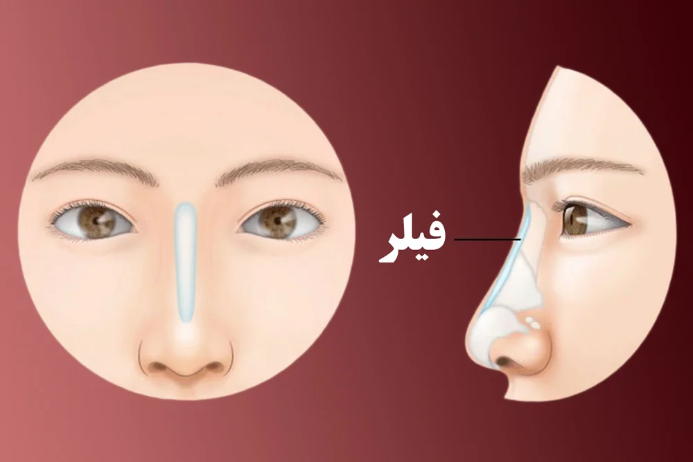 منظور از تزریق فیلر به بینی چیست؟