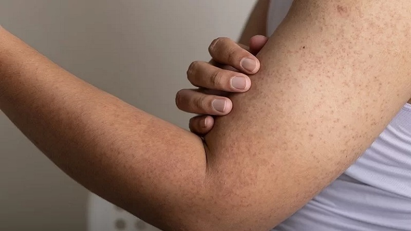 علل و علائم بیماری پوست مرغی