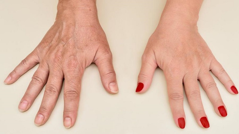 تزریق فیلر دست