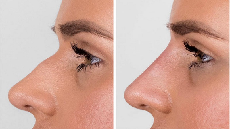 اصلاح تیغه بینی با تزریق فیلر | پزشک زیبایی اصفهان | دکتر مجید حسینی