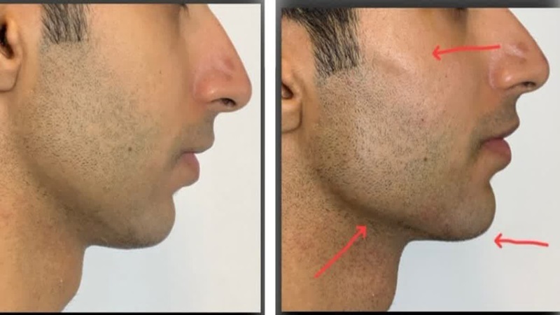 تزریق فیلر به گونه‌ها، زاویه فک و چانه | پزشک زیبایی اصفهان | دکتر مجید حسینی