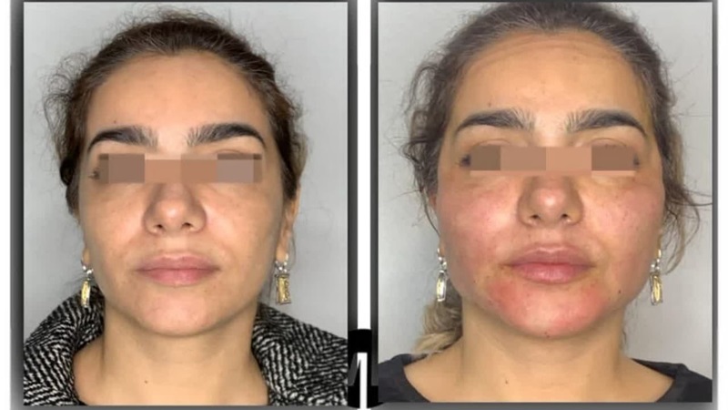 نمونه تزریق چربی به صورت با تکنیک میکروفت