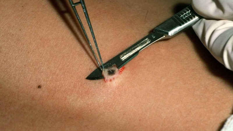 نمونه‌برداری پوستی