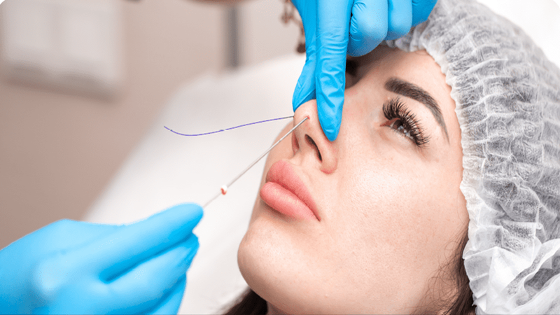 چه زمانی نیاز به لیفت بینی با نخ داریم؟