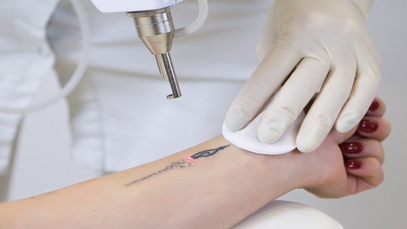 آیا بعد از لیزر تتو لک می‌شود؟