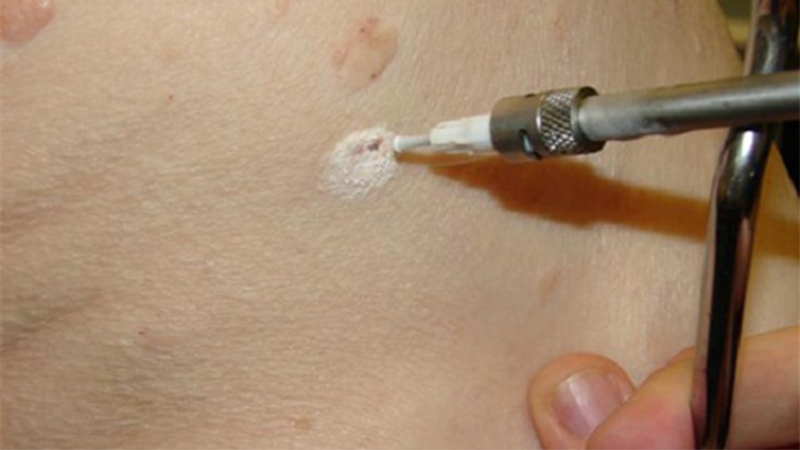 سوزاندن زگیل تناسلی