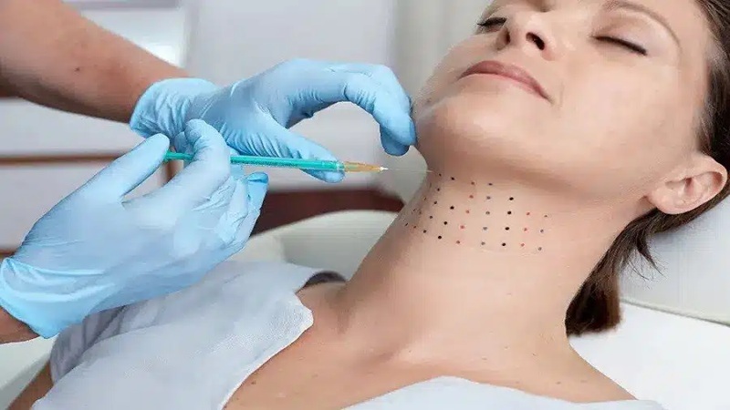 مزوتراپی غبغب