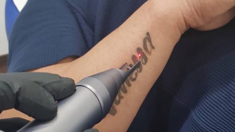 برای حذف تتو با دستگاه پیکوسکند چند جلسه لازم است؟