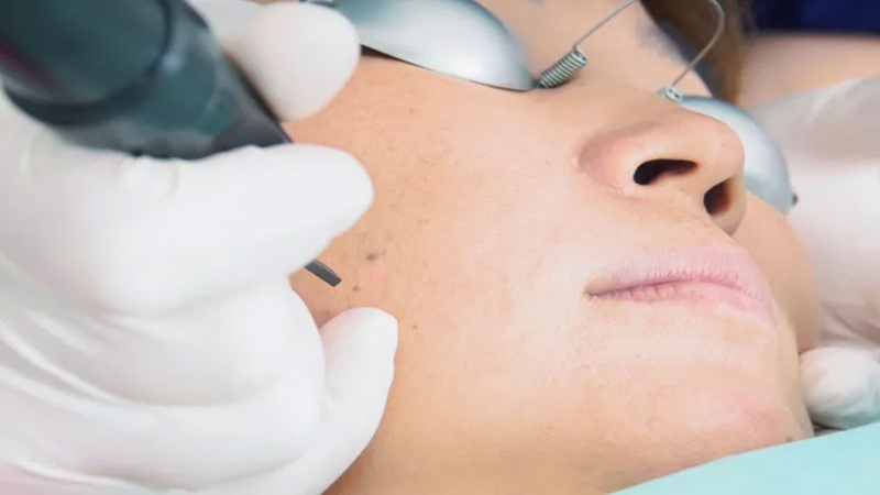 درمان لک و کک و مک با لیزر پیکوسکند