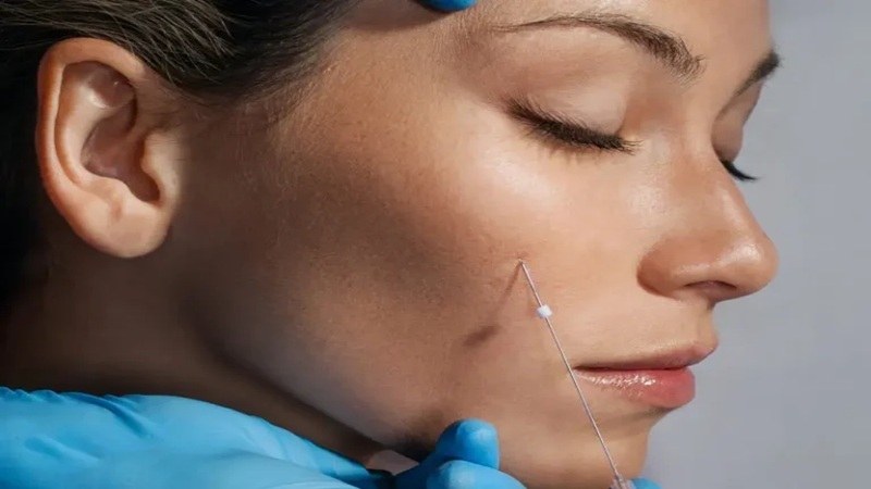 عوارض احتمالی لیفت با نخ