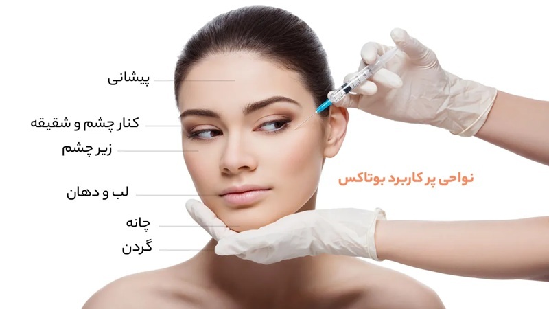 بهترین نواحی برای تزریق بوتاکس