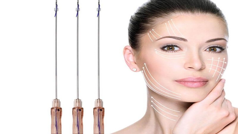 با مراحل انجام لیفت با نخ آشنا شوید.