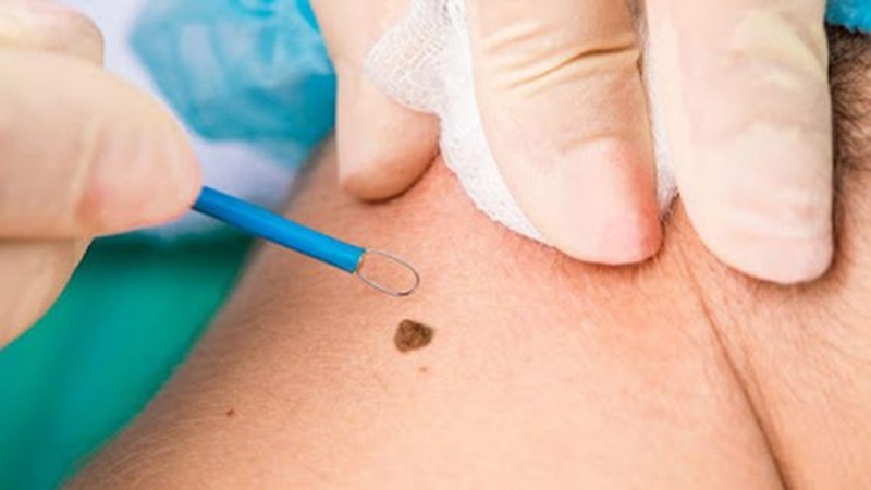 برداشتن خال و زگیل