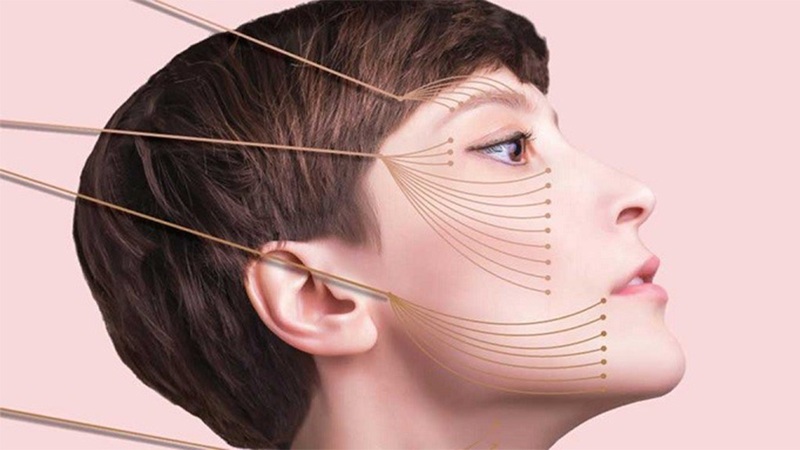 مزایا و معایب لیفت با نخ