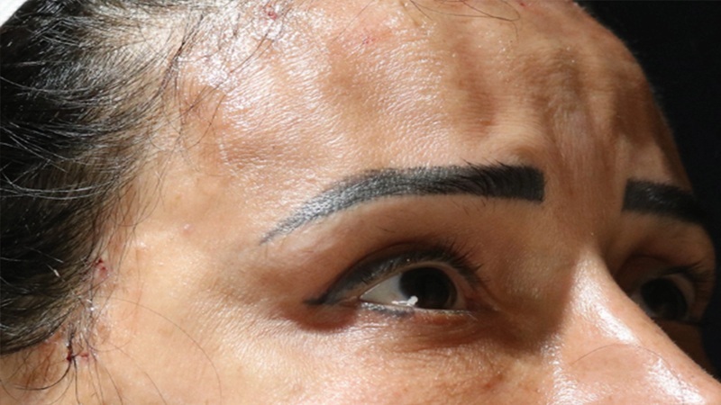 عوارض جانبی لیفت با نخ