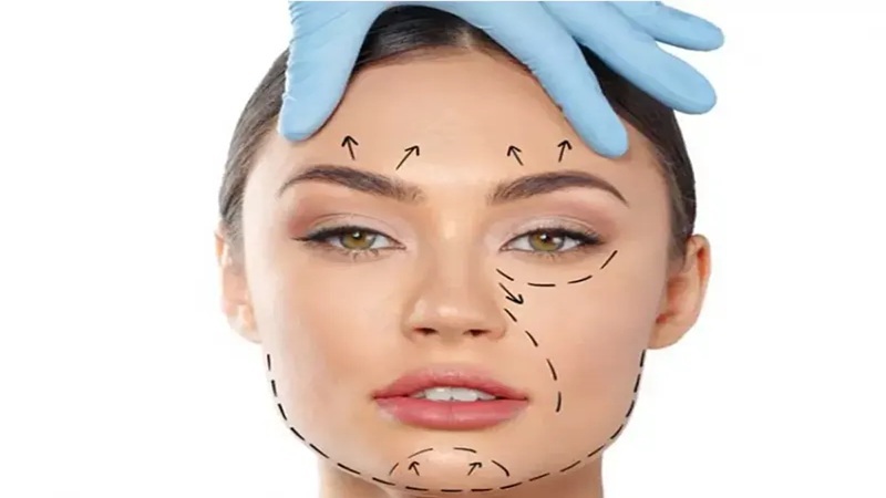 مزایای لیفت با نخ نسبت به جراحی