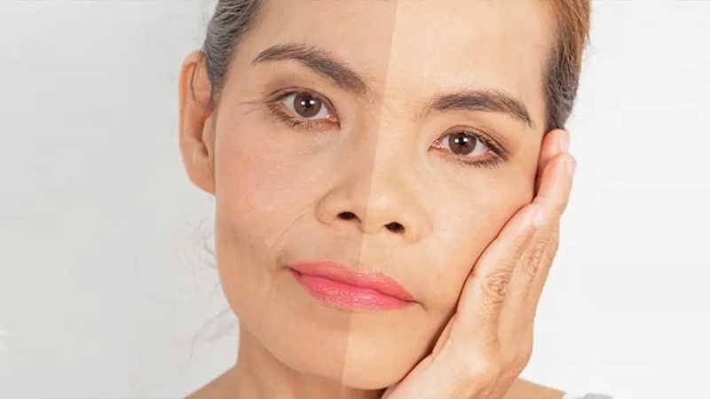 نقش بوتاکس در کاهش خطوط خنده و پیشانی