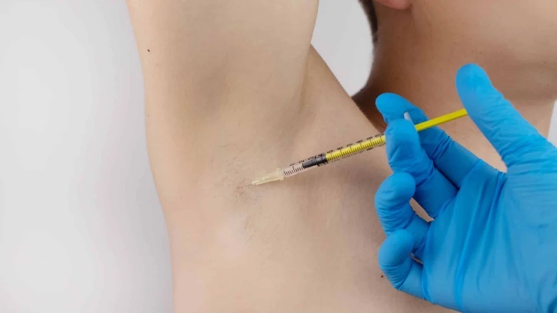 بوتاکس برای درمان تعریق زیاد (هایپرهیدروزیس)