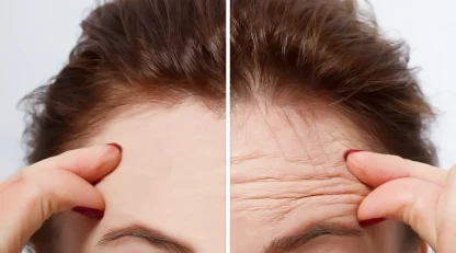 نحوه عملکرد بوتاکس در کاهش چین و چروک