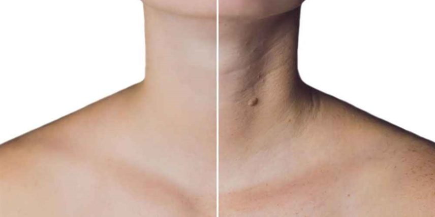 بوتاکس در جوانسازی ناحیه گردن و دکلته